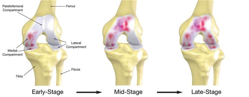 Treatment knee pain
