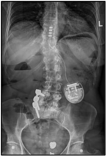 spinal cord stimulant image