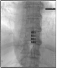 spinal cord stimulant image