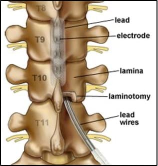 spinal cord stimulant image