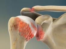 Osteoarthritis of the Shoulder