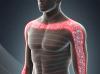 Cervical Radiculopathy