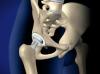 Total Hip Replacement Portland