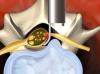 Micro Endoscopic Discectomy