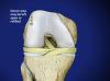 OATS Cartilage Repair Surgery