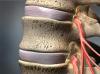 Spinal Stenosis