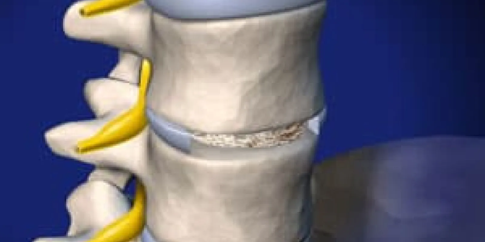 Anterior Lumbar Interbody Fusion 