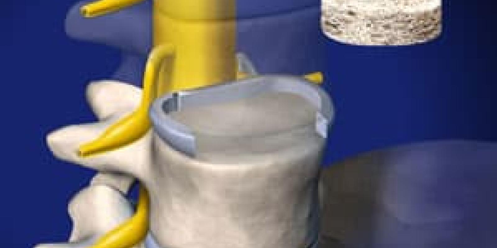 ALIF: Anterior Lumbar Interbody Fusion 