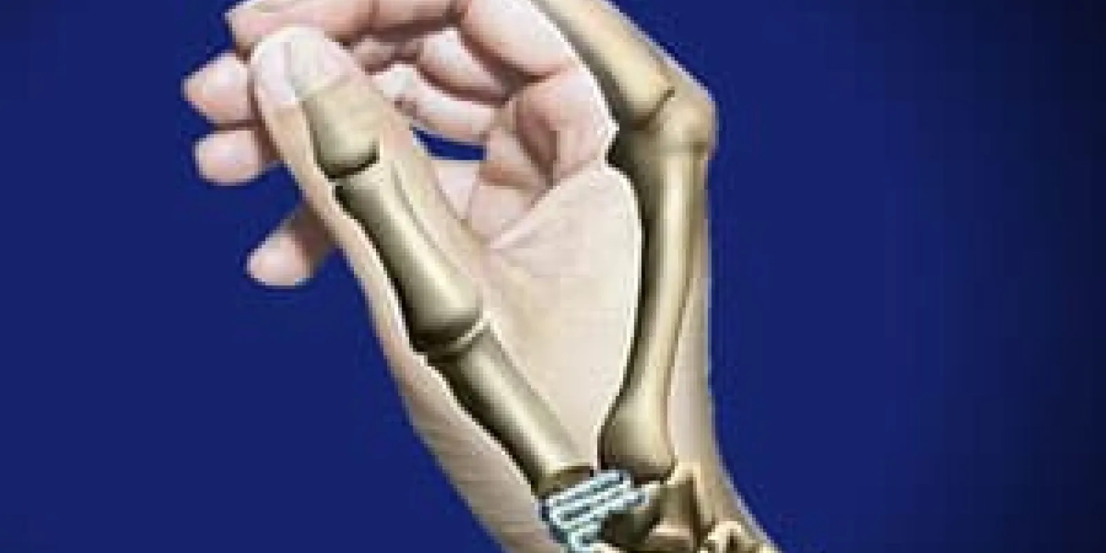 Basal Joint Surgery