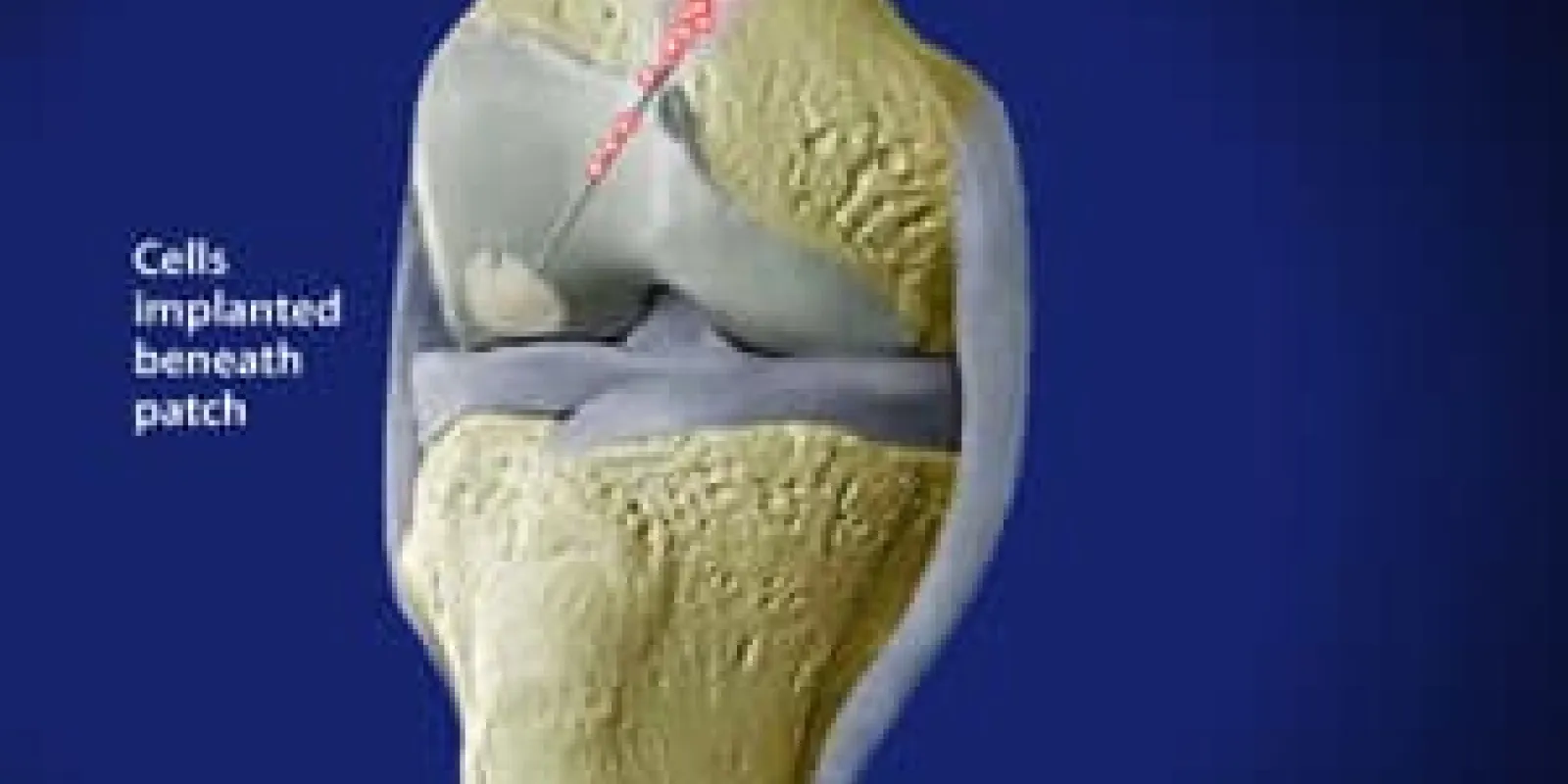 Cartilage Repair