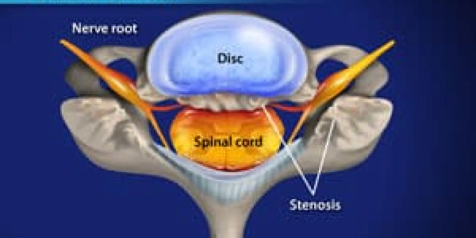 Laminectomy (Cervical) with Fusion