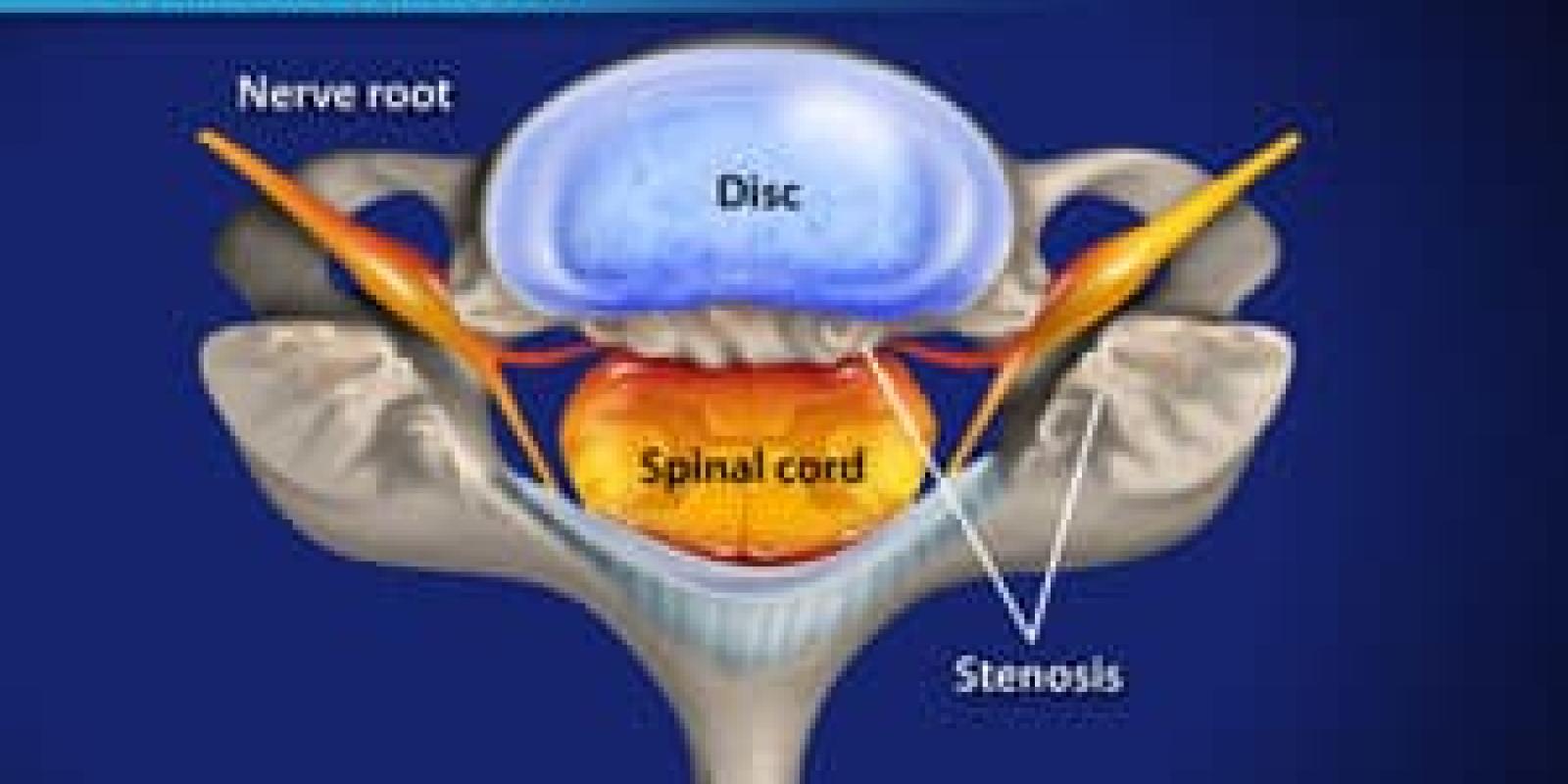 Laminectomy (Cervical) with Fusion