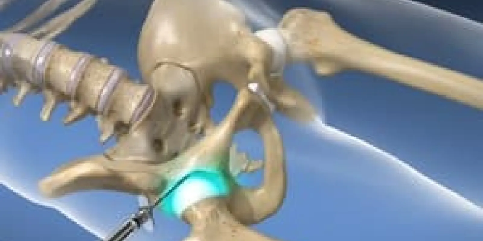 Hip Joint Injection