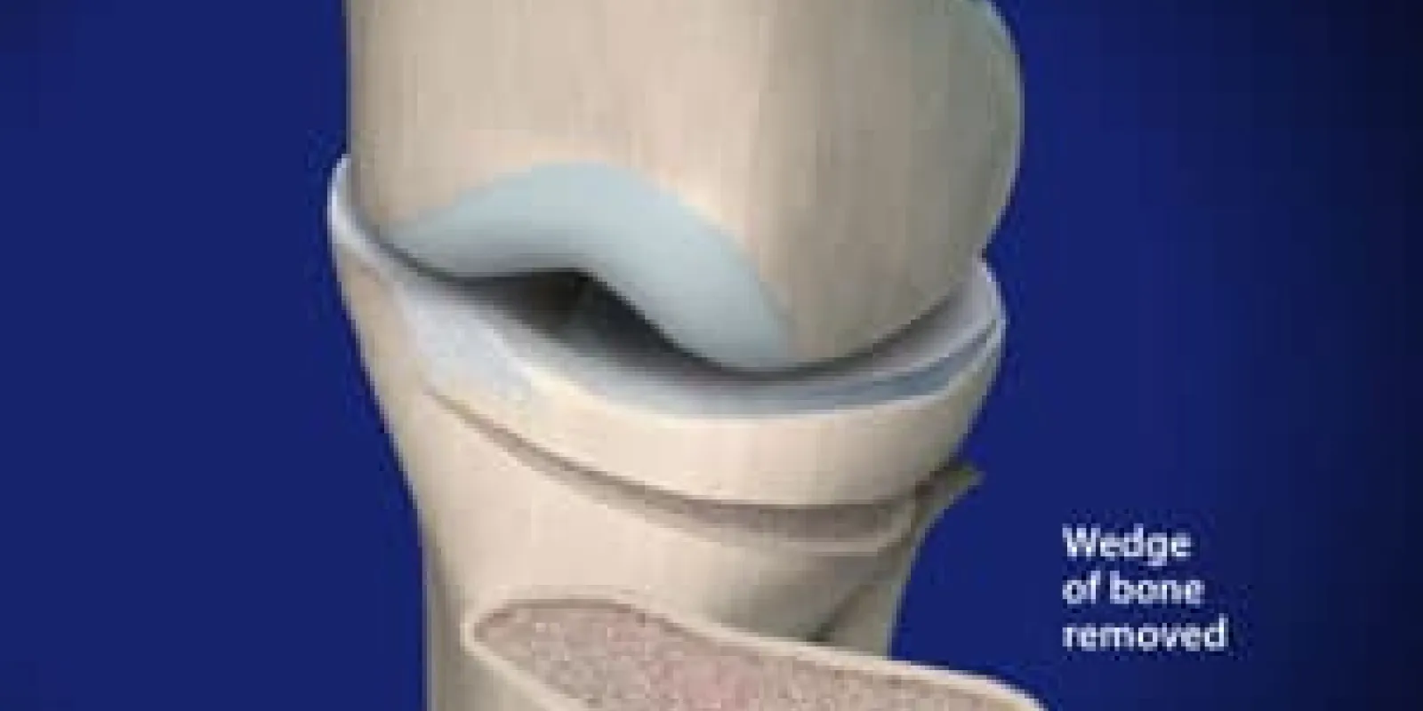 High Tibial Osteotomy