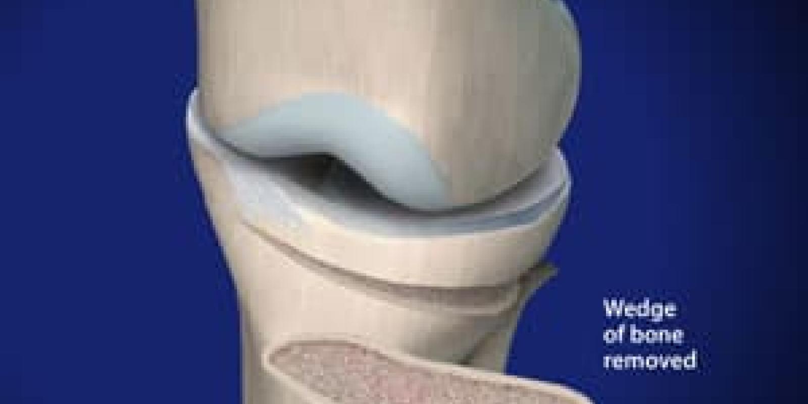 High Tibial Osteotomy