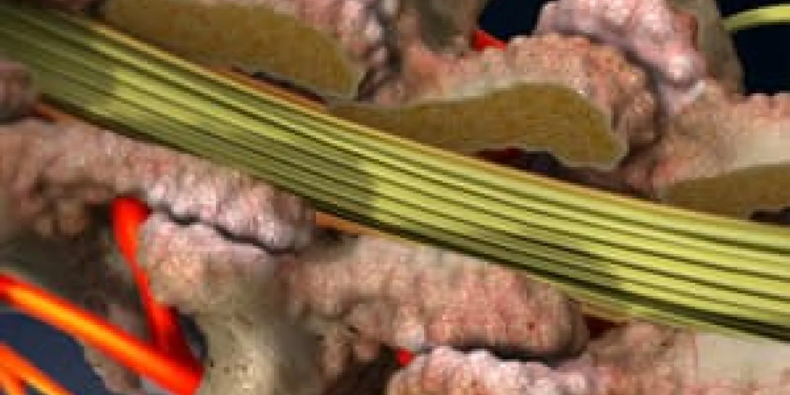 Laminectomy