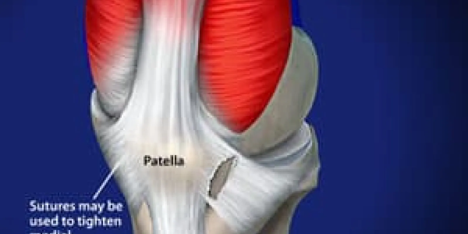 Lateral Release and Medial Imbrication