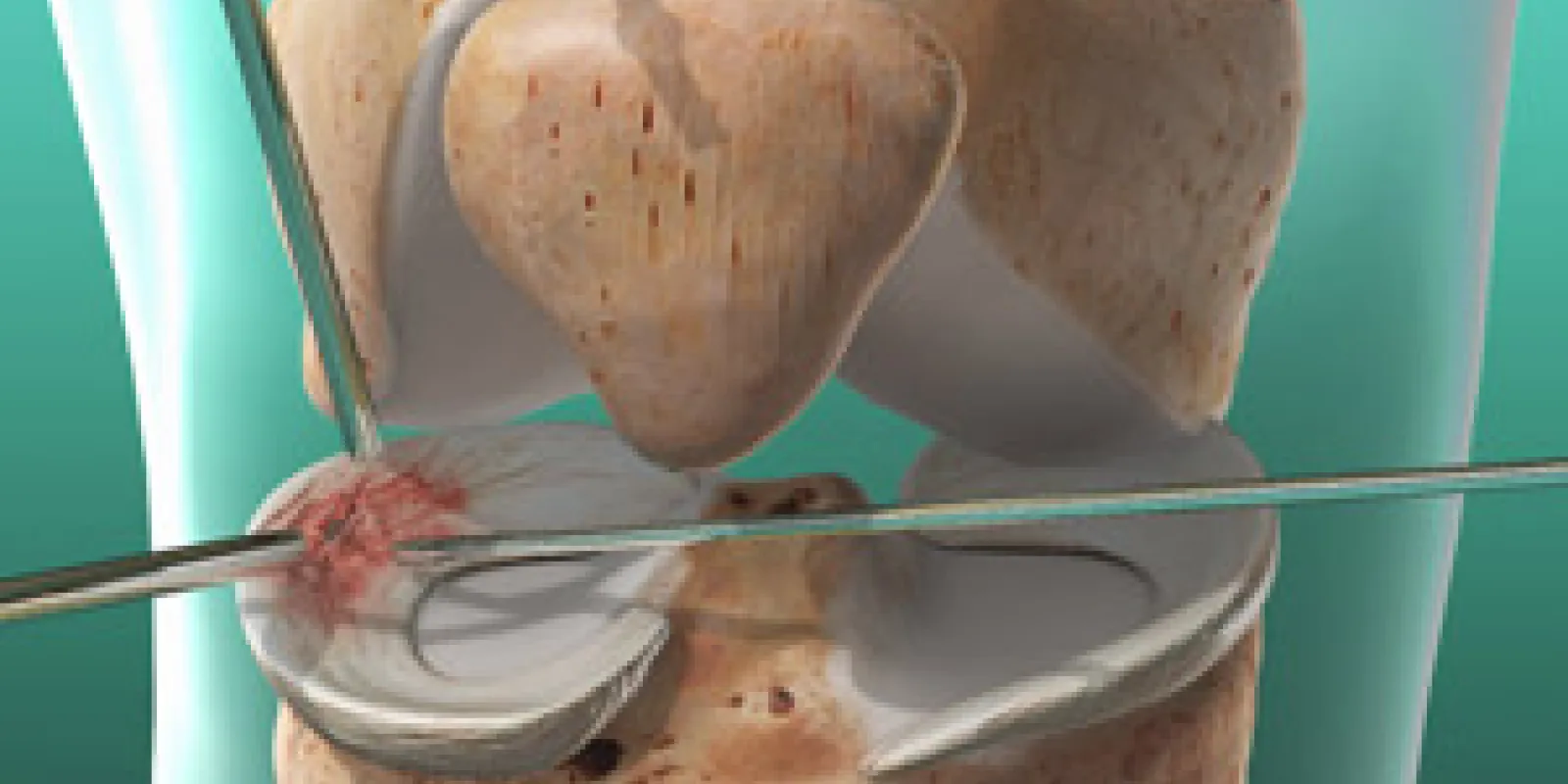 Meniscus Repair