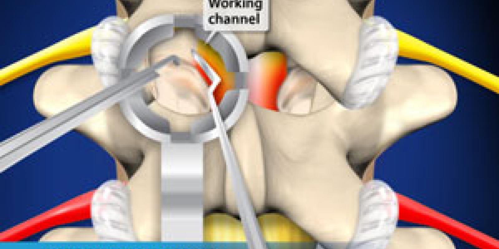 Minimally-Invasive Lumbar Microdecompression