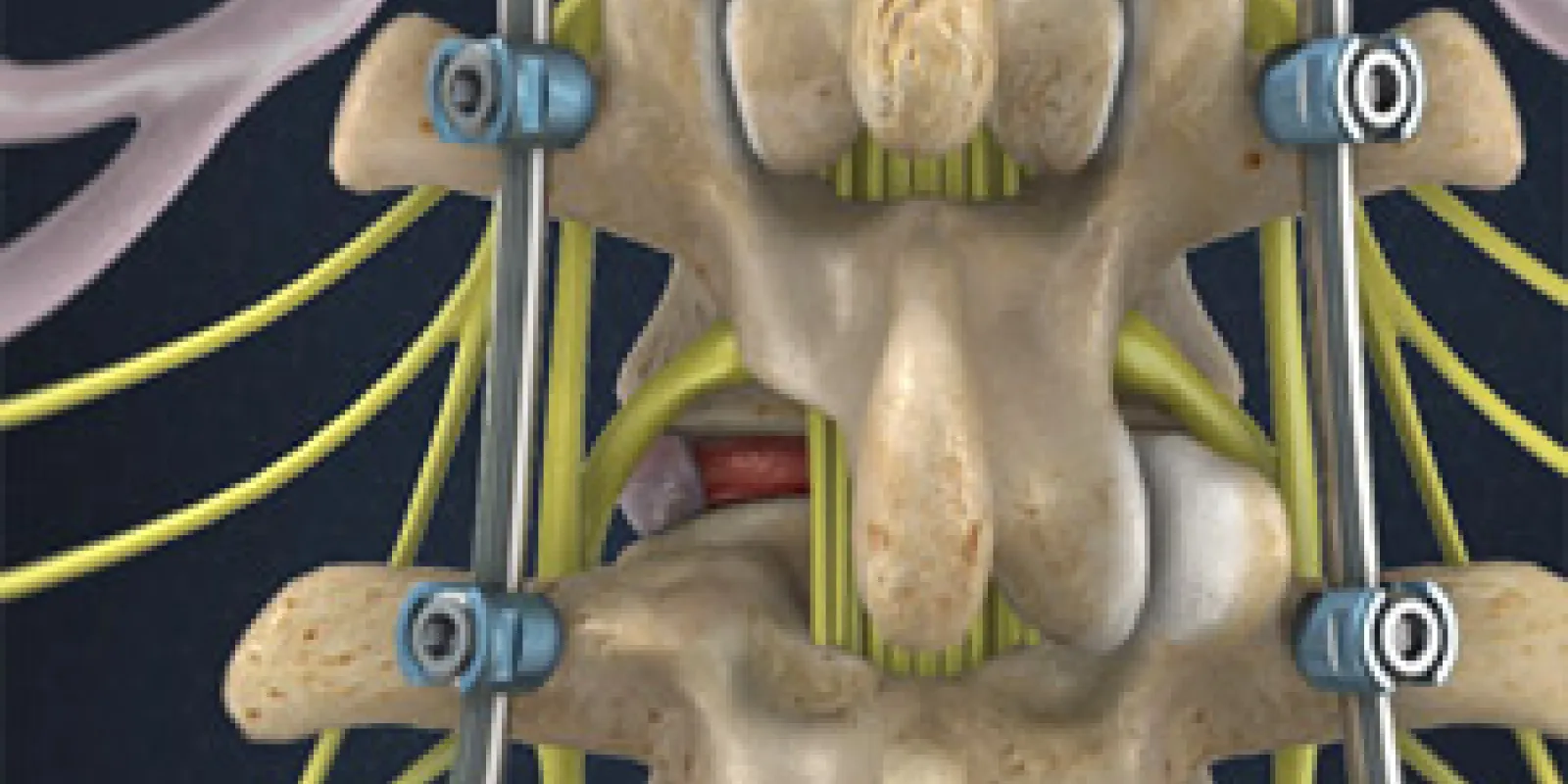 Minimally-Invasive TLIF