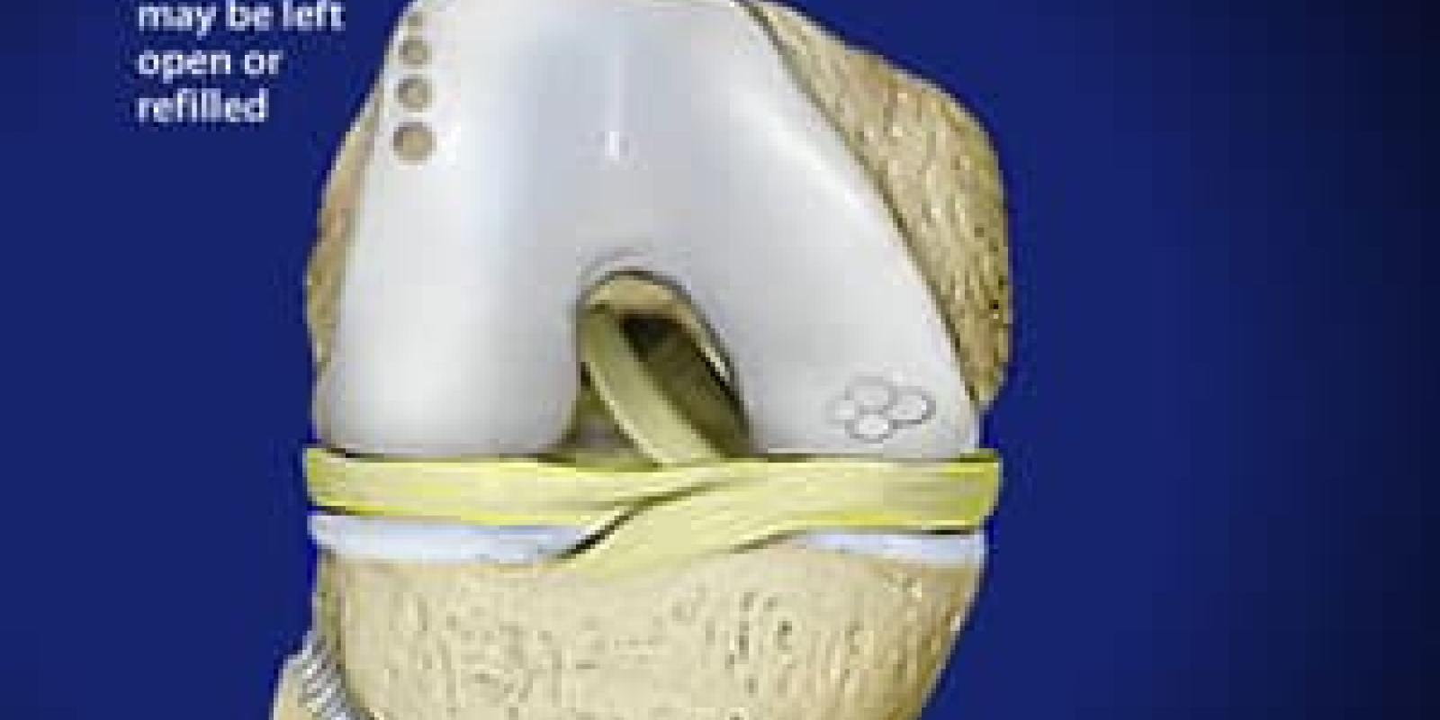 OATS Cartilage Repair Surgery