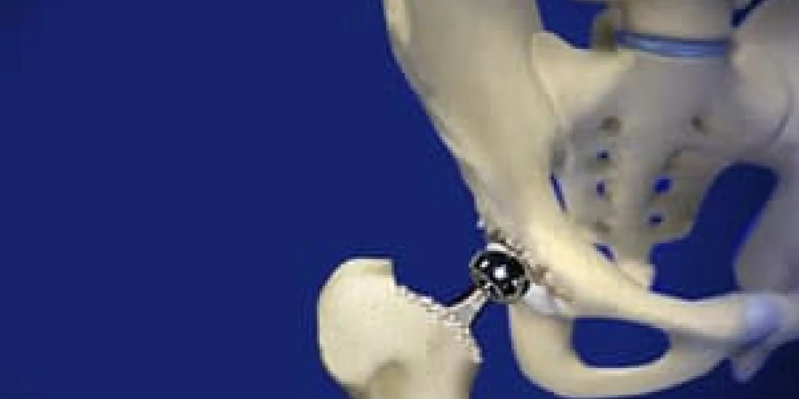 Revision Hip Surgery