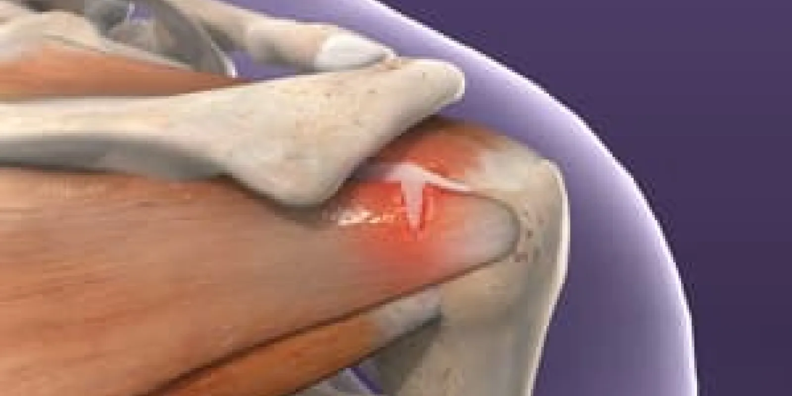 Rotator Cuff Injuries
