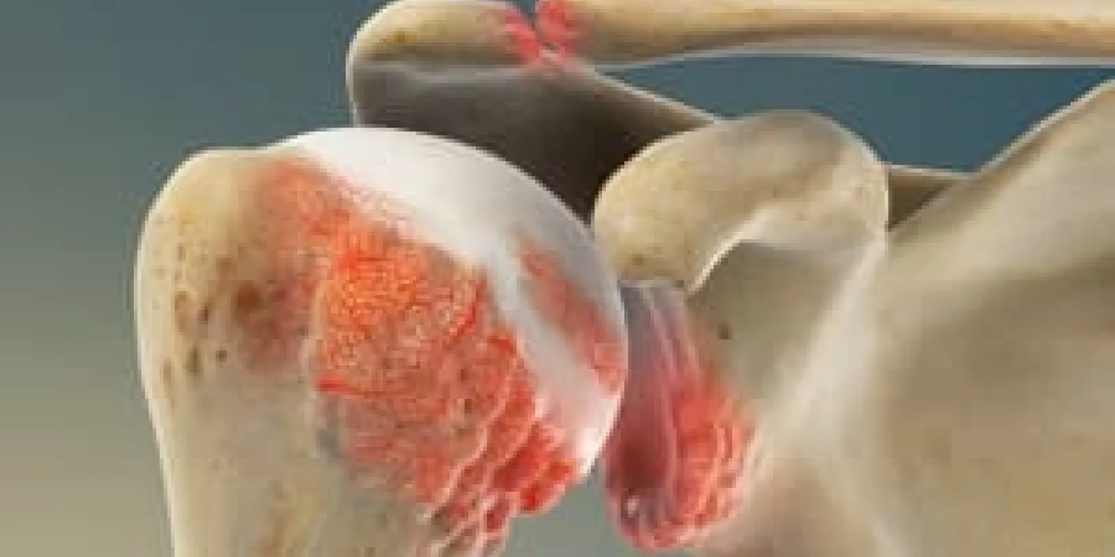 Osteoarthritis of the Shoulder