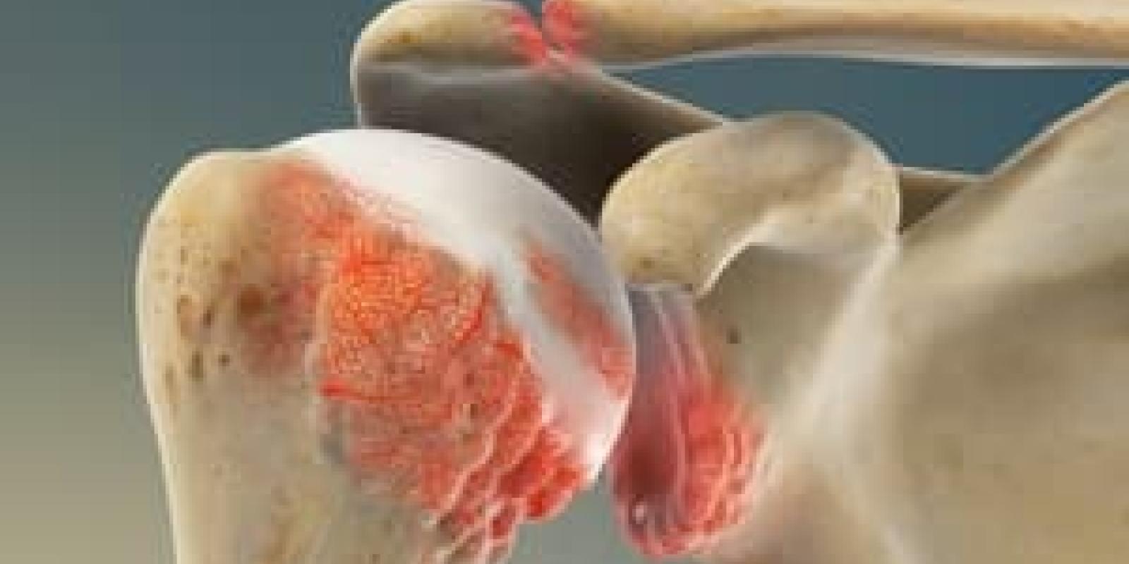 Osteoarthritis of the Shoulder