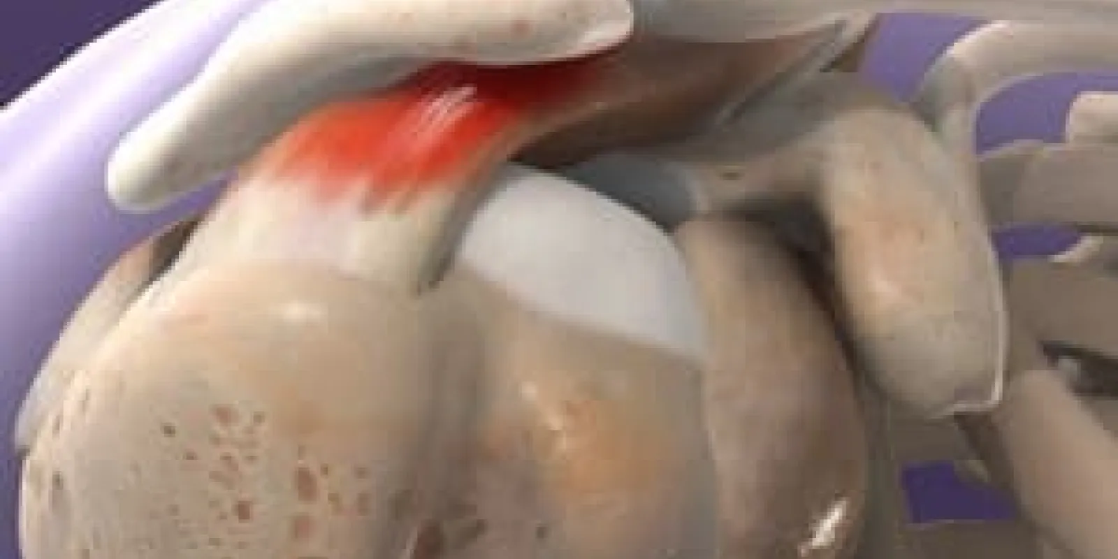 Subacromial Decompression