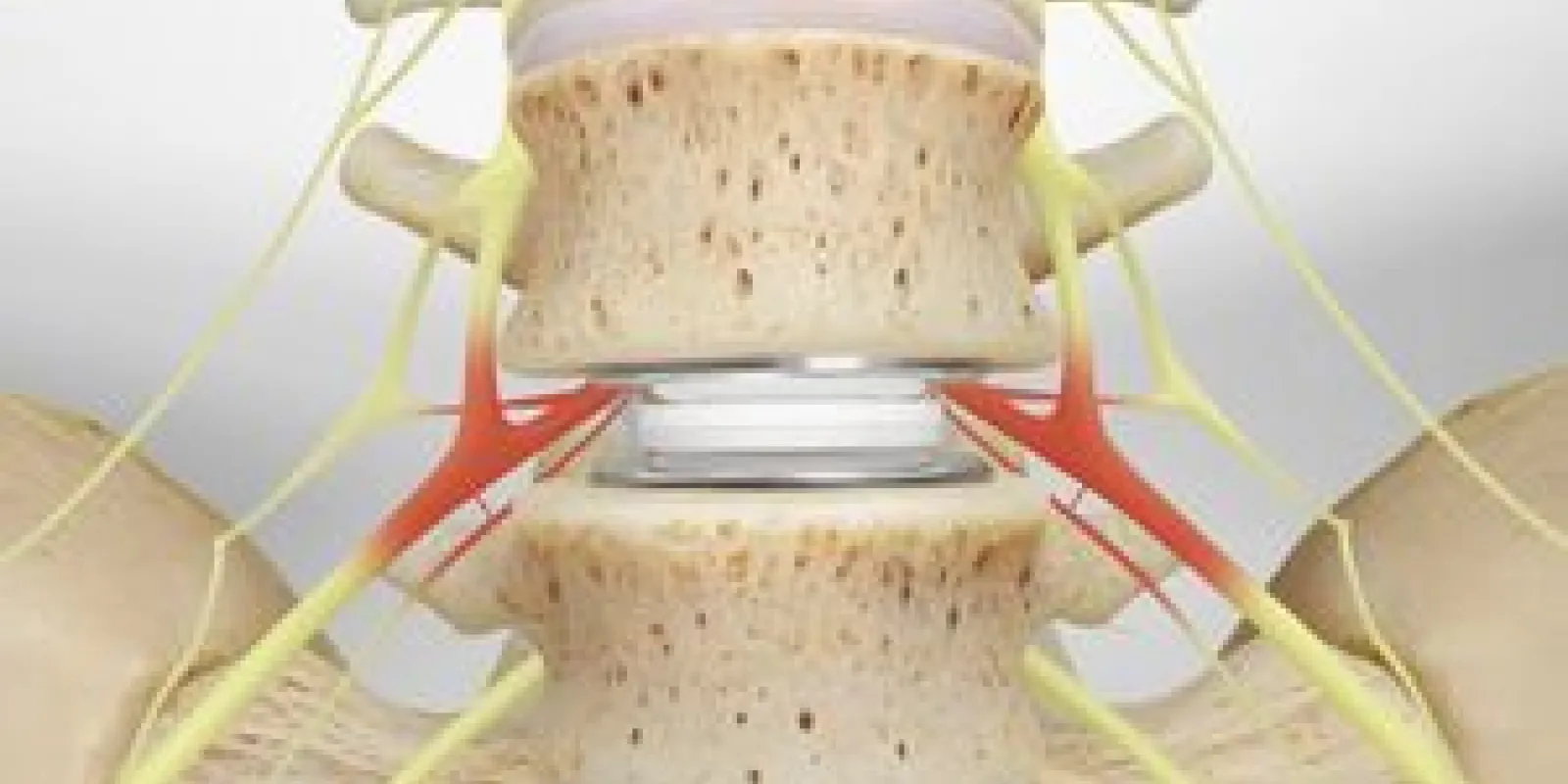 Artificial Disc Replacement (in the Lumbar Spine)