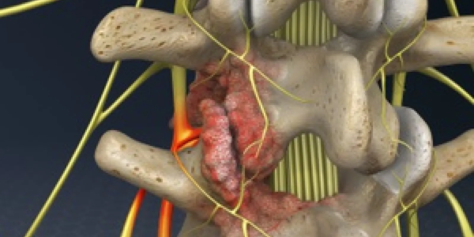 Foraminotomy (Lumbar Spine)