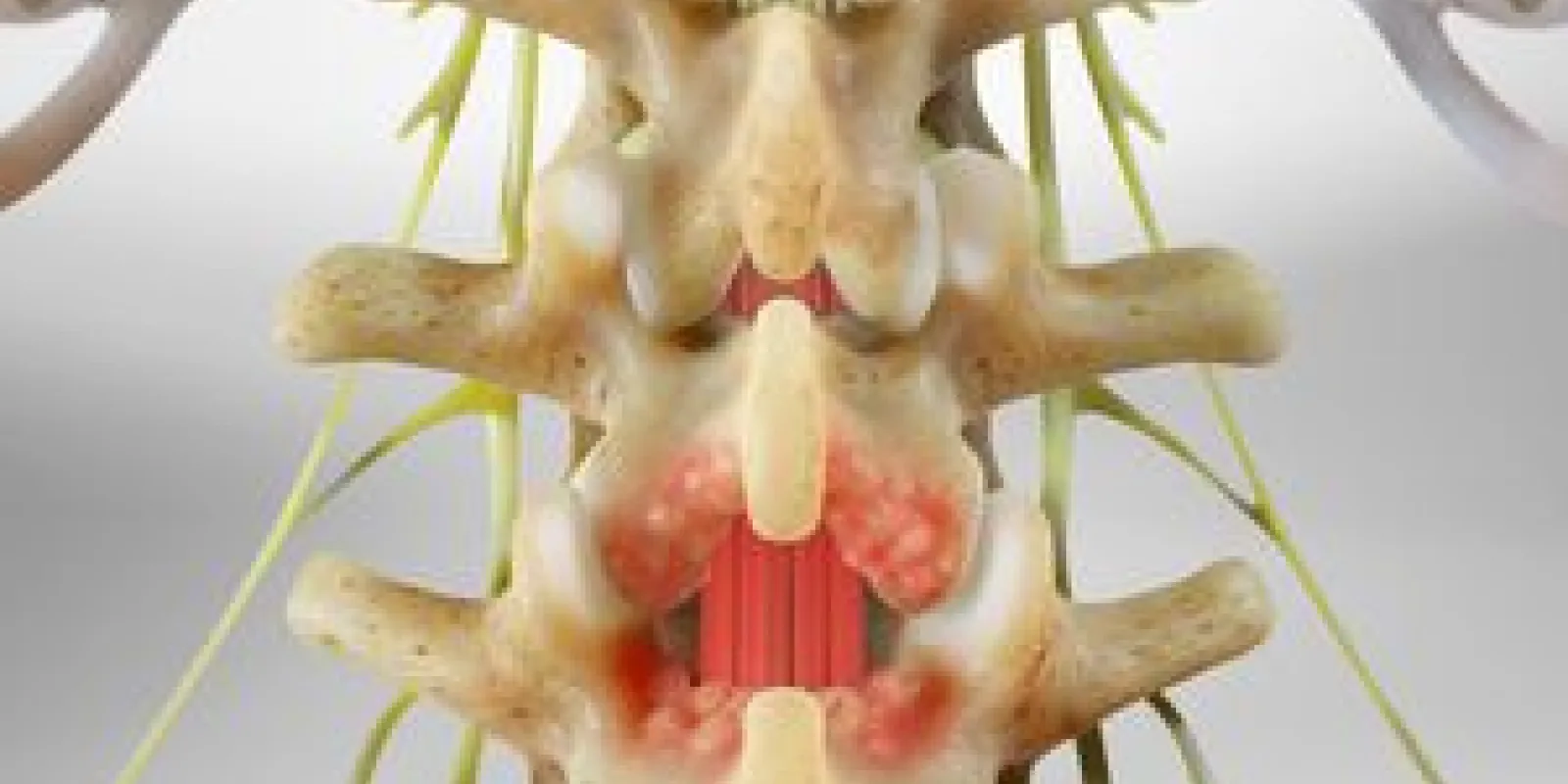 Laminotomy (of the Lumbar Spine)