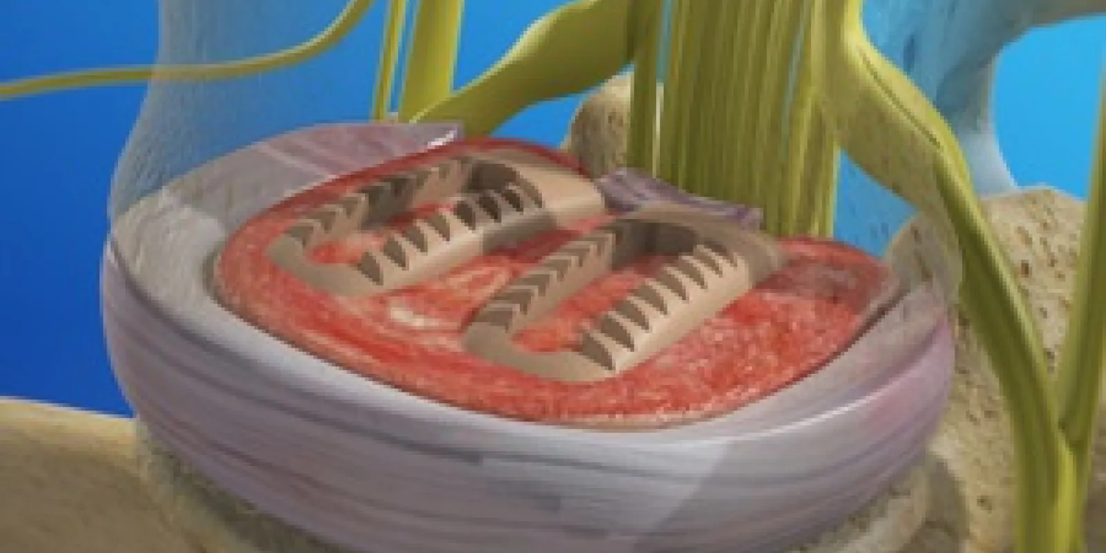 Posterior Lumbar Interbody Fusion (PLIF)