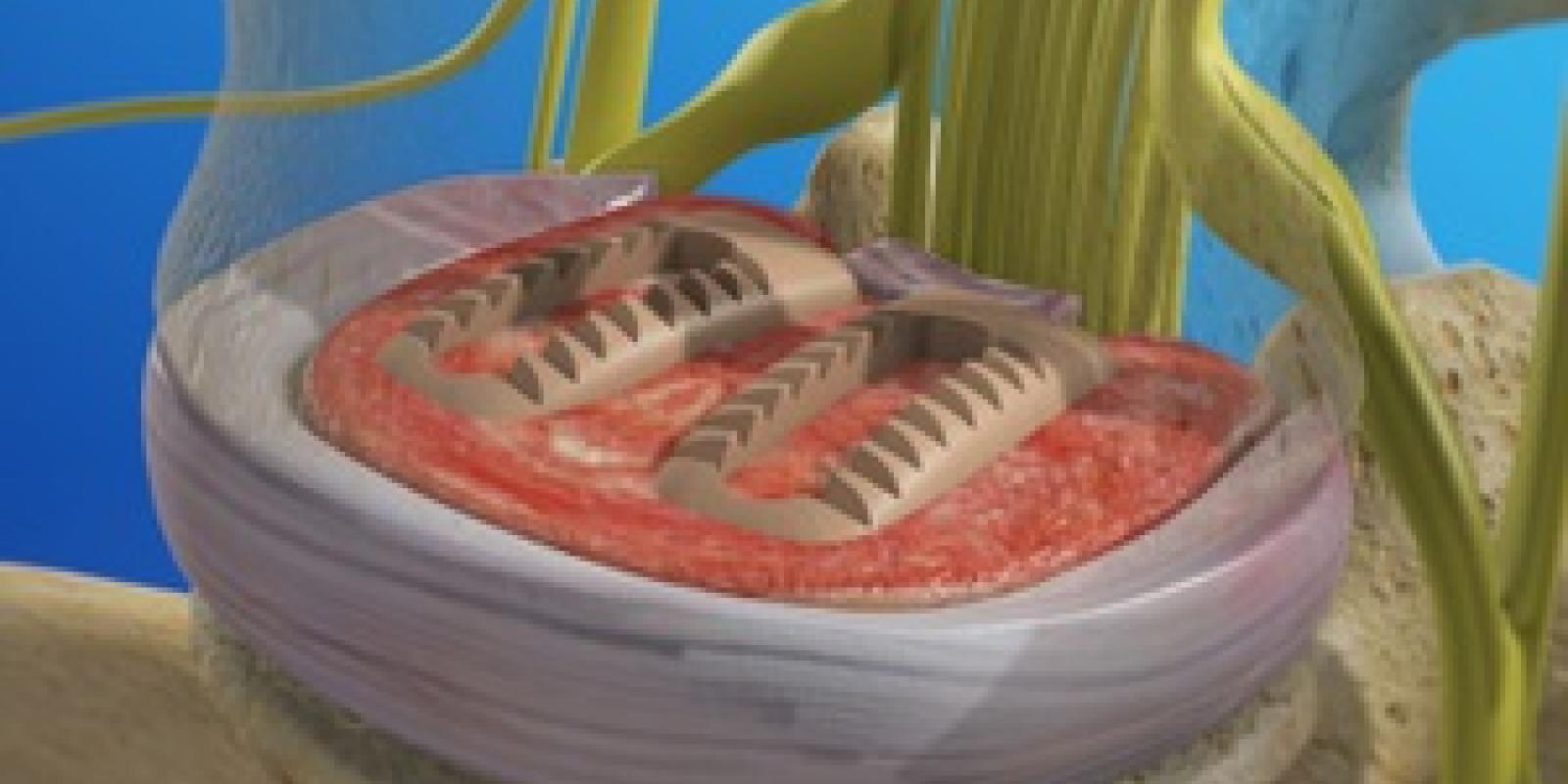 Posterior Lumbar Interbody Fusion (PLIF)