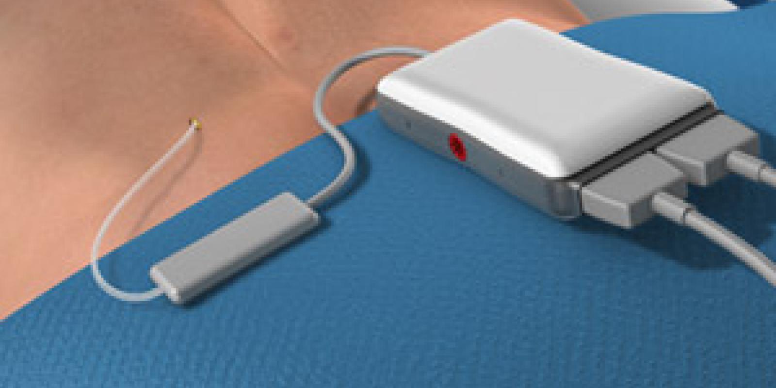 Spinal Cord Stimulator Implant (Trial Procedure)