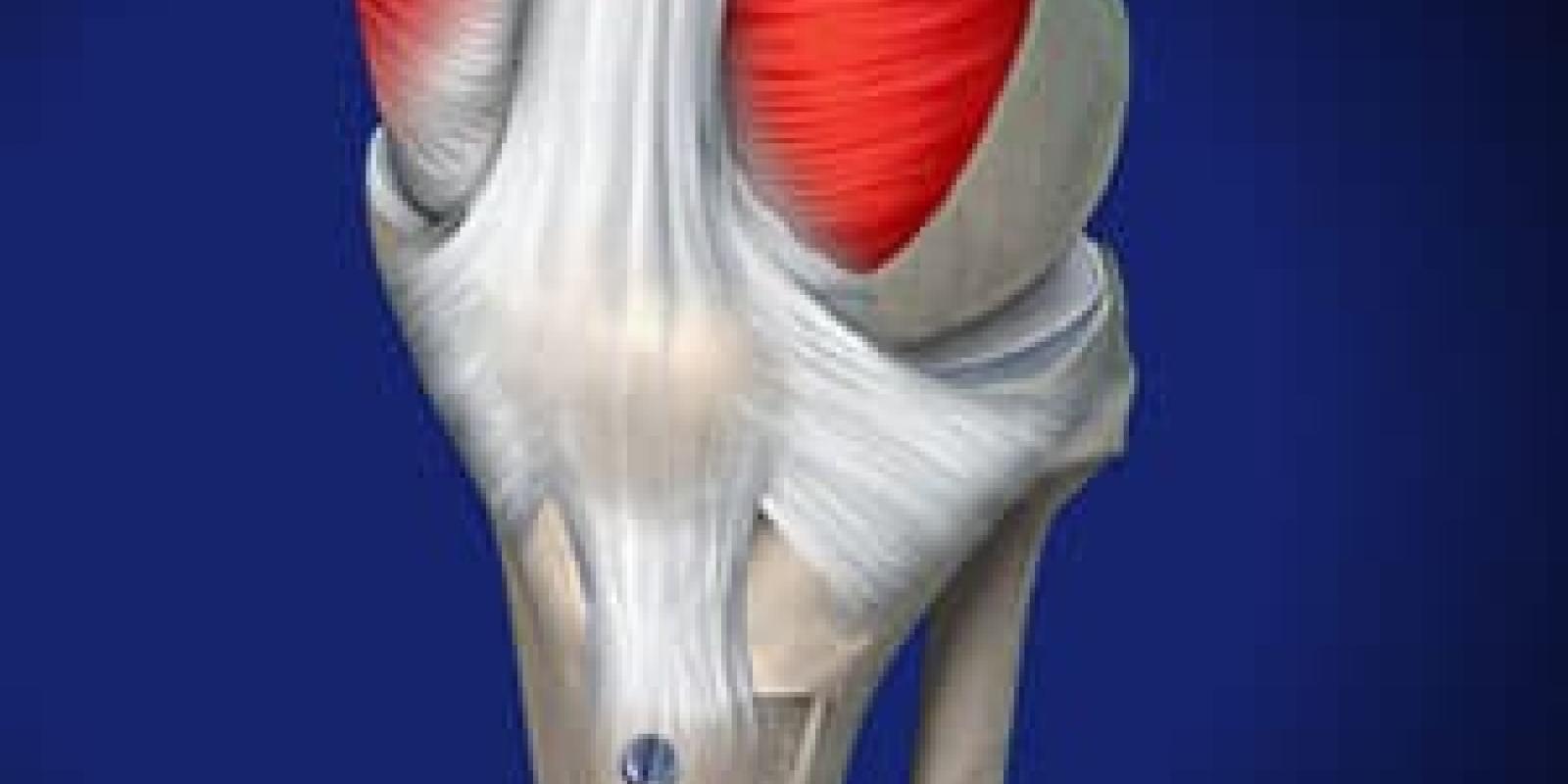 Tibial Tubercle Osteotomy