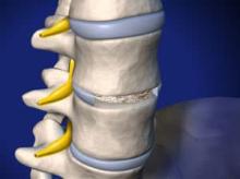 Anterior Lumbar Interbody Fusion 