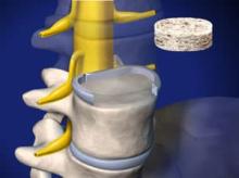 ALIF: Anterior Lumbar Interbody Fusion 