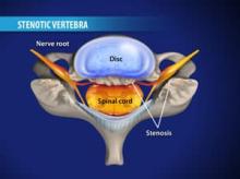 Laminectomy (Cervical)