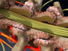 Laminectomy