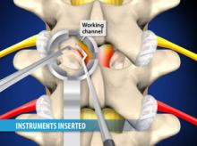 Minimally-Invasive Lumbar Microdecompression