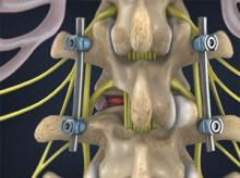Minimally-Invasive TLIF
