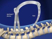 Lumbar Pedicle Screw Fixation