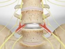 Artificial Disc Replacement (in the Lumbar Spine)