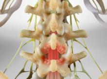 Laminotomy (of the Lumbar Spine)