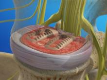 Posterior Lumbar Interbody Fusion (PLIF)