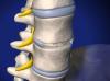 Anterior Lumbar Interbody Fusion 