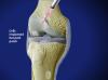 Cartilage Repair