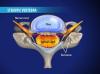 Laminectomy (Cervical) with Fusion